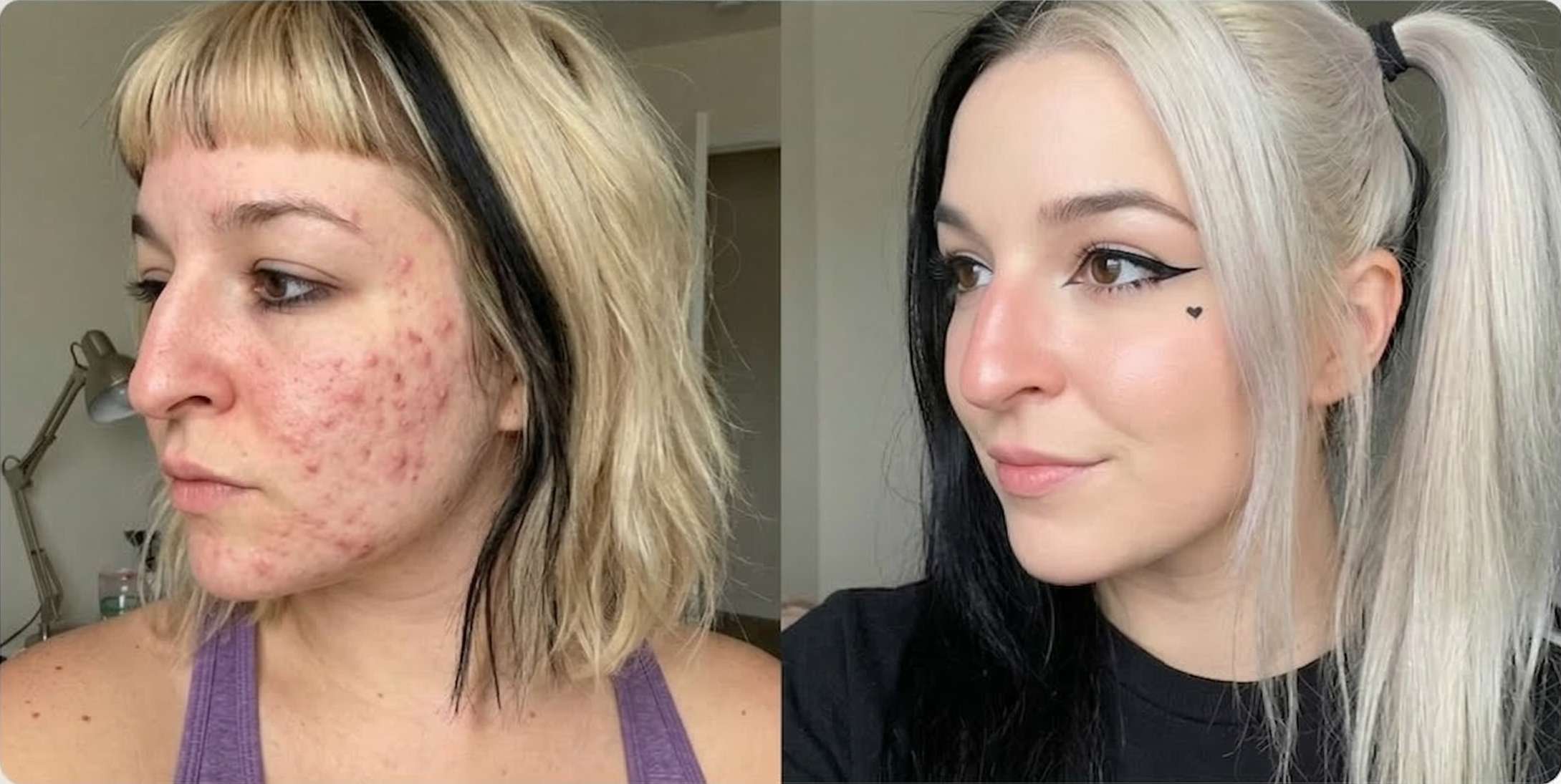 Before and After Face Yoga - Visibly Lifted Eyelids